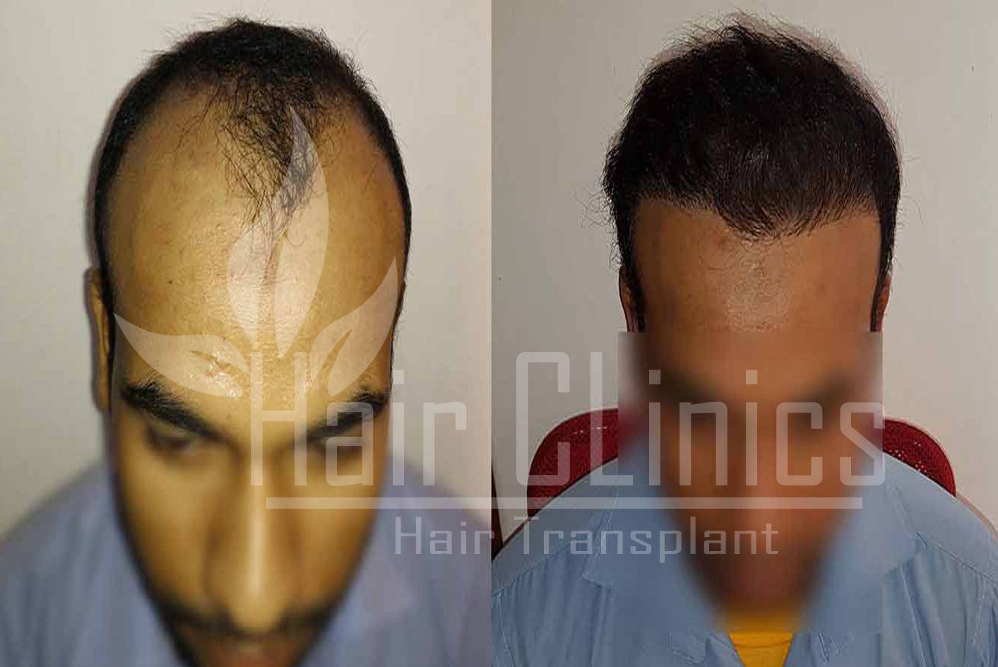 Kanpur | Advance FUE, FUT, PRP Therapy Hair Transplant Clinic in Kanpur | Hair  Transplant At Lowest Cost in Kanpur