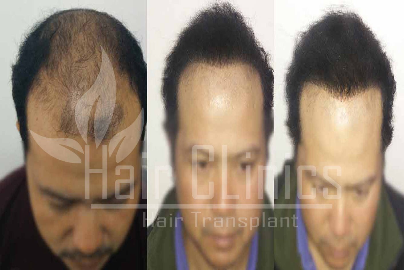 Hair Transplant results for 3500 grafts in Kanpur